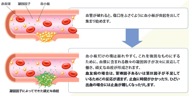 血が止まるしくみと血友病
