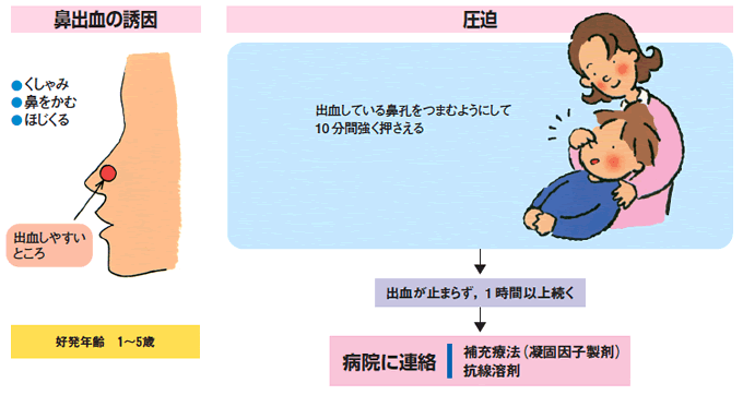 Title 鼻出血(はなぢ)の時は、どうすればよいのでしょうか。
