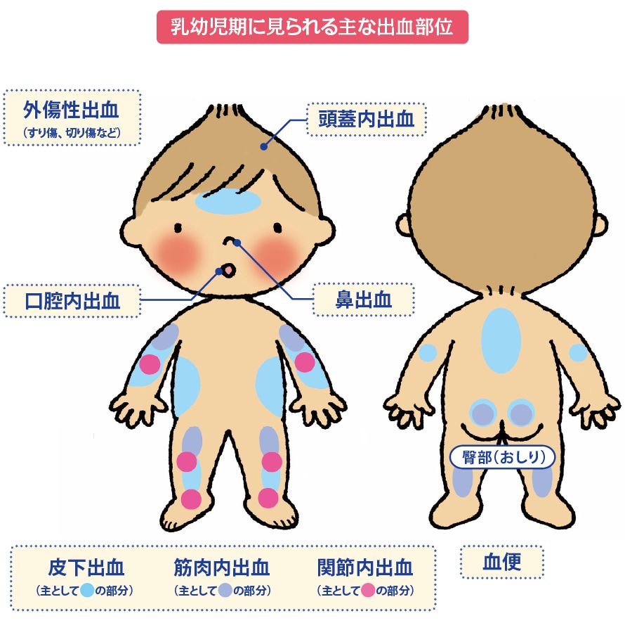 乳幼児期に見られる主な出血部位のイラスト