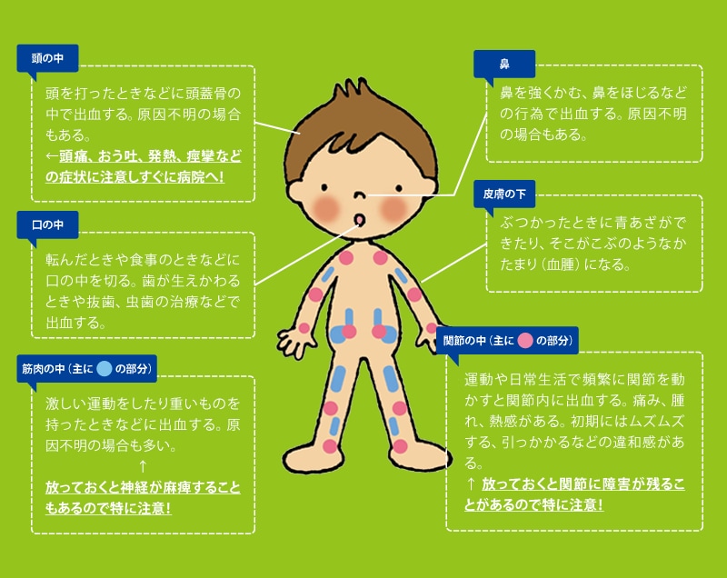 血友病の症状のイラスト